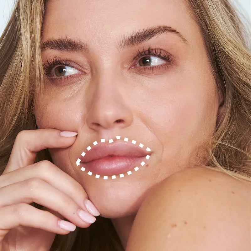 Lip Enhancement at Happy Family Dental, St Albans